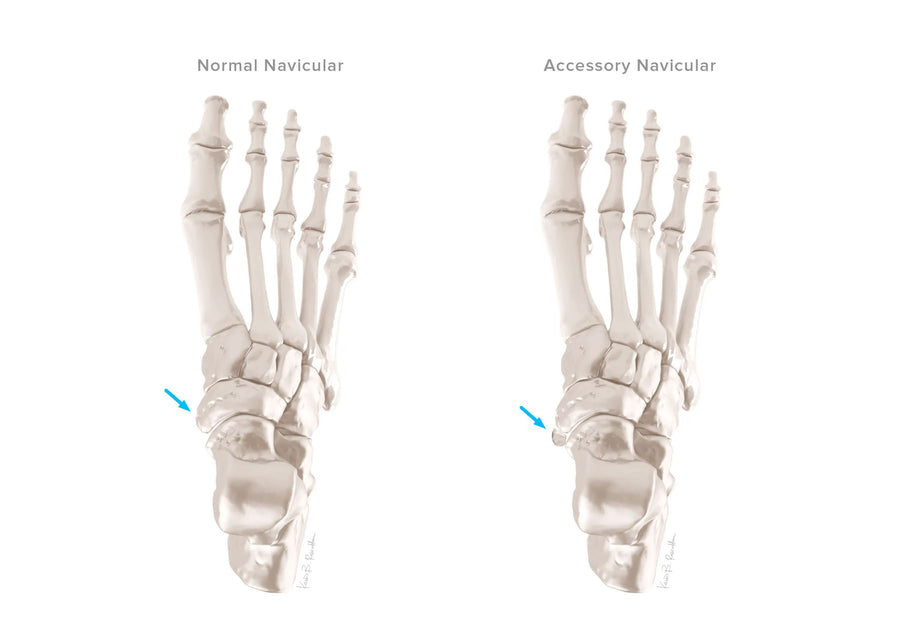 Accessory Navicular Syndrome | Foot Condition & Orthotic Management ...