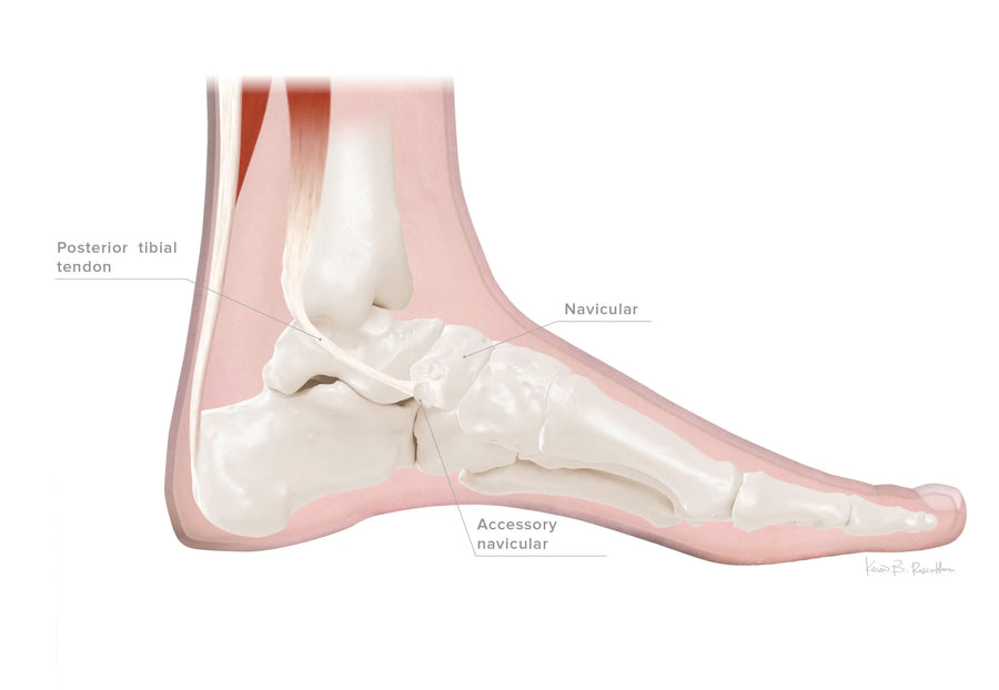 Accessory Navicular Syndrome illustration 1