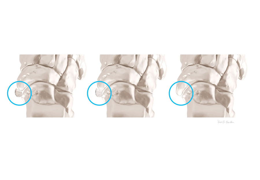 Accessory Navicular Syndrome illustration 2