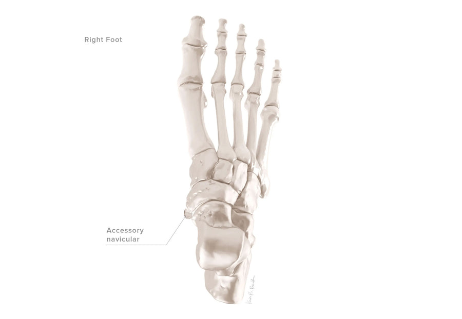 Accessory Navicular Syndrome illustration 3