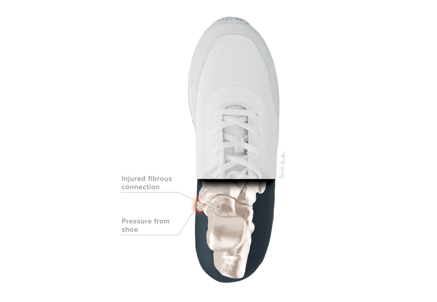 Accessory Navicular Syndrome illustration 4