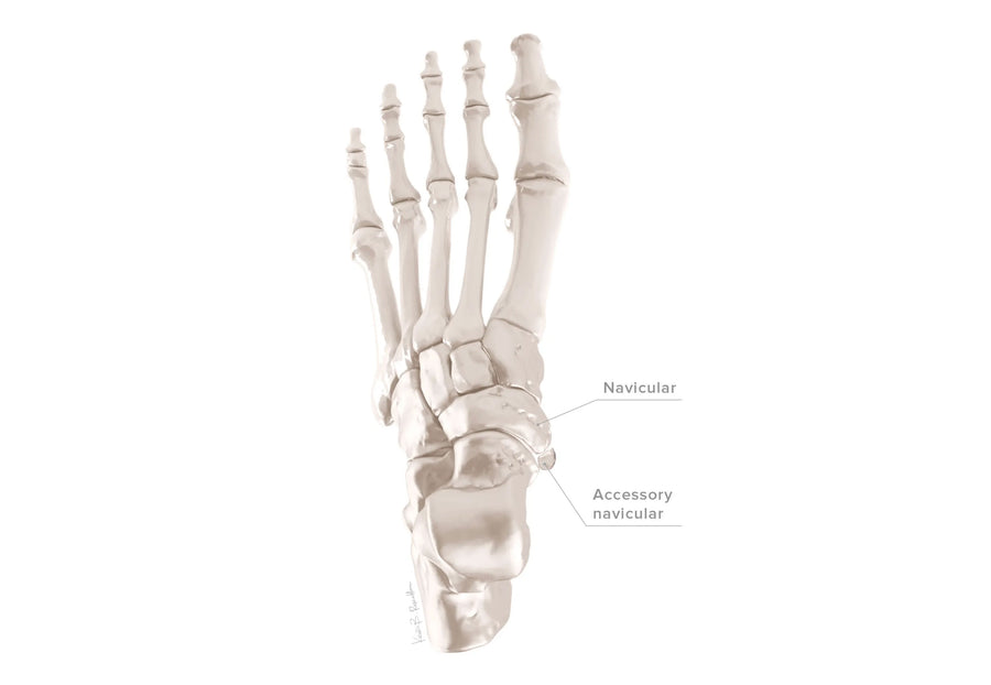 Accessory Navicular Syndrome illustration 5