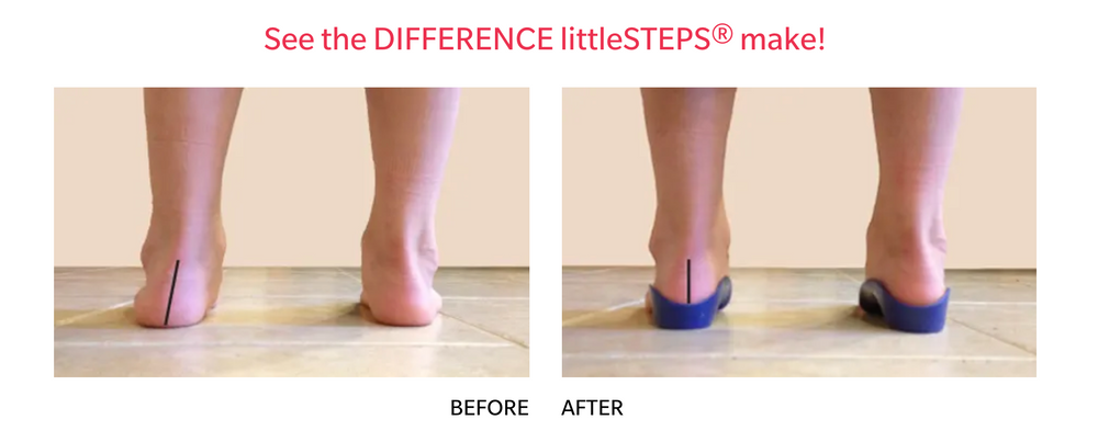 LittleSteps®: foot orthotics for kids - KevinRoot Medical