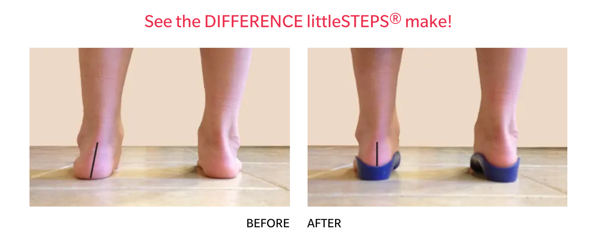 LittleSteps foot orthotics for kids